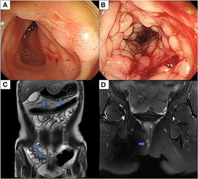 Development of Spinal Tuberculosis in an Adolescent With Crohn's Disease After Infliximab Therapy: A Case Report With Literature Review